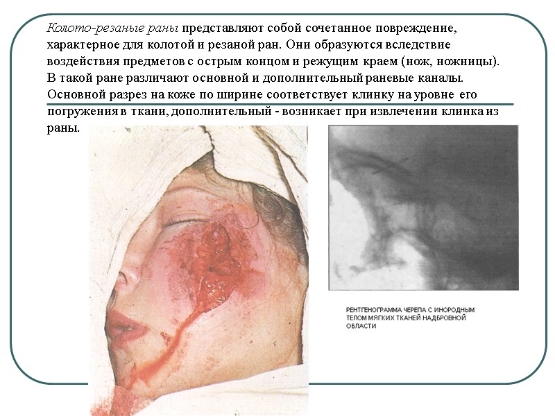Колото-резаные раны представляют собой сочетанное повреждение,  характерное для колотой и резаной ран. Они